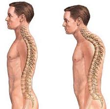 Kifoz Nedir? Kifoz Nedir?
